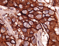 Tissue Microarray Analysis